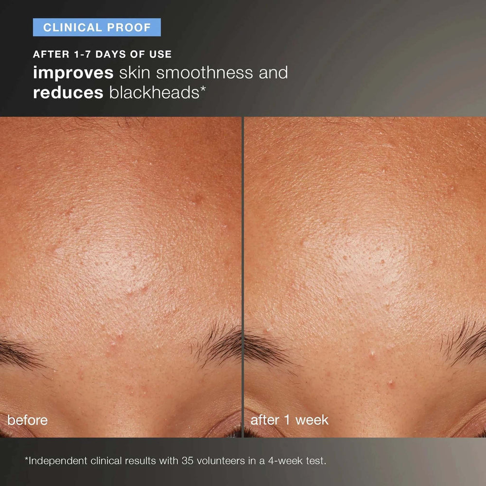 Before and after skin comparison showing improvements in smoothness and reduced blackheads.