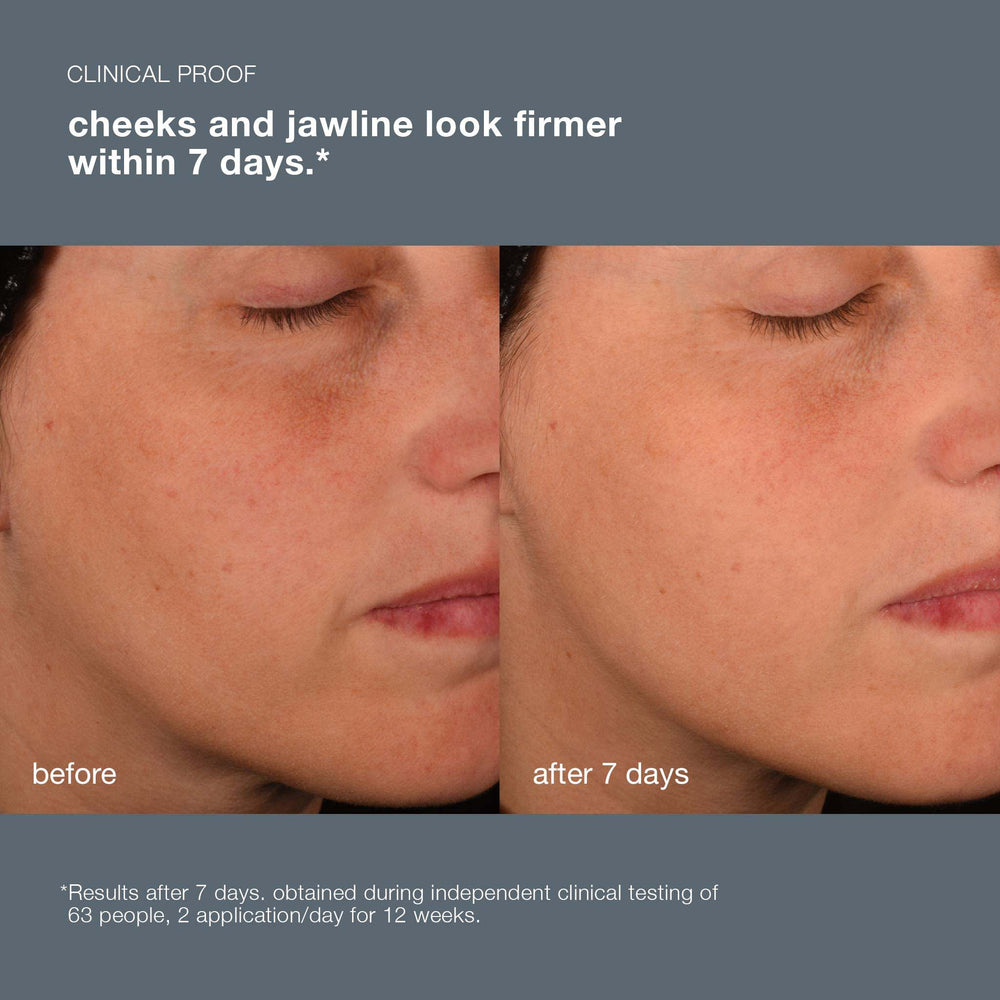 Before and after comparison of a person's face showing firmer cheeks and jawline.