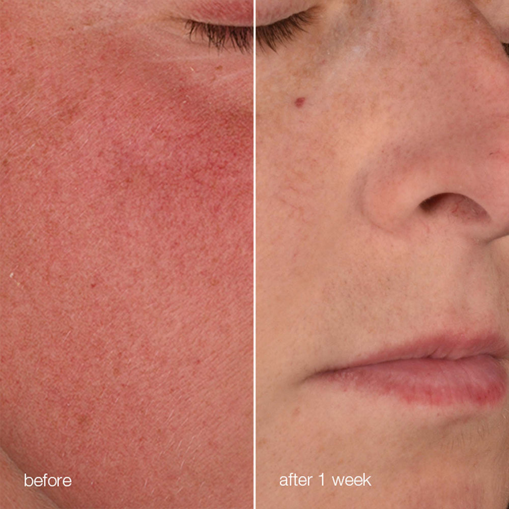 Before and after comparison of skin texture on a person's face.